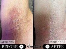 アングレイス(Anngrace)/【全身脱毛わき】Before/After