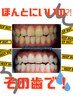 残り17／20名(黄ばみサヨナラ激落とし美白ホワイトニング)11000→¥1980