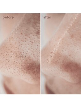 ティンクルホワイト 上尾店/鼻/Tゾーン部分毛穴洗浄施術