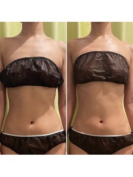 カルナ(CARNA)/最強トリプル痩身ケア