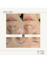 ティンクル(Twinkle)/繰り返すニキビや肌荒れ