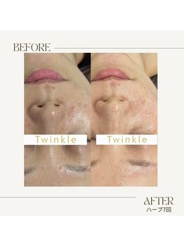 ティンクル(Twinkle)/繰り返すニキビや肌荒れ