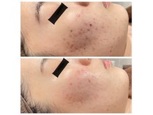 ジャスミン(Jasmin)の雰囲気(根本からの肌育。プラペン×原液100%幹細胞10回)