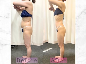パラディ(PARADIS)の写真/【40代からの落ちないお腹に】集中引き締めケア