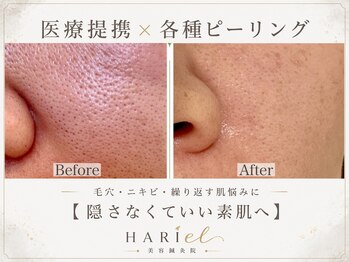 美容鍼灸院ハリエル(HARIel)の写真/毛穴・ニキビ・くすみに◎肌管理ピーリングでつるんと素肌へ