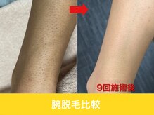 ミスターアンクール 鹿児島(Mr.uncoeur)/腕脱毛9回後