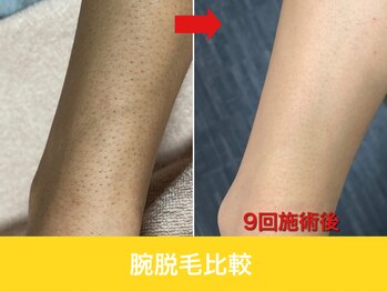 ミスターアンクール 鹿児島(Mr.uncoeur)/腕脱毛9回後