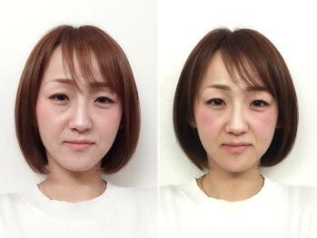 ゆうき式小顔矯正/小顔矯正before&after