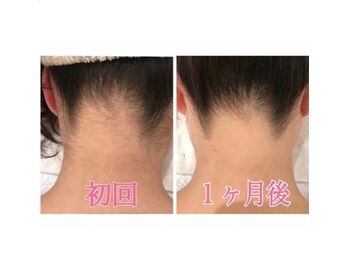 プラス ファースト(Plus 1st)/うなじ脱毛♪