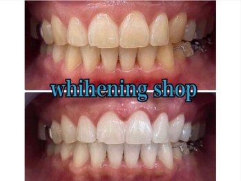 ホワイトニングショップ 鳥取店/ホワイトニングビフォーアフター
