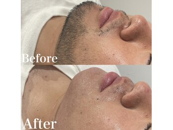 アルゴ 熊本光の森店(ALGO)/【ヒゲ】大人気クーポン♪