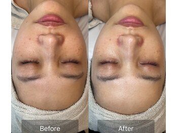 ビオトナス(Facial Esthe)/ララピール施術前後