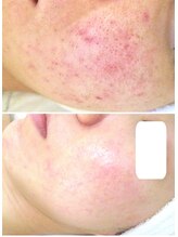 サロンドエステケイワイ(de KY)/フェイシャル☆ニキビ改善