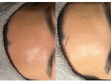 モガナ(mogana)/フェイスクリーニング１回