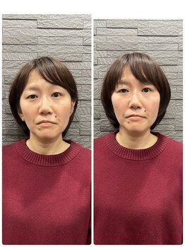 長寿鍼灸院 長寿整骨院/美容鍼50本の効果★小顔効果