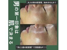 オンフリーク(ON FLEEK)の雰囲気（メンズフェイシャル♪男性は皮脂の分泌量が多く毛穴ケアはマスト）