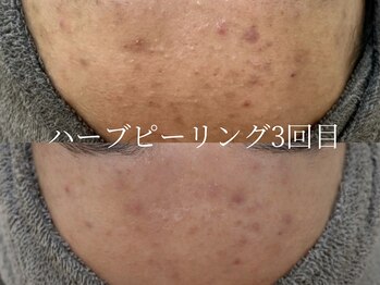 フォア(foi)/慢性化 ニキビ・肌荒れ