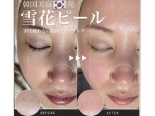 ラズ(Luz)/雪花ピールの人気が止まらない