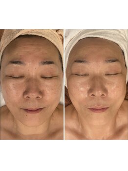 トータルエステティック ジョワイユ(JOYEUX)の写真/毛穴開き黒ずみしみくすみしわをケア！老け顔疲れ顔から若見えリフトアップ目指そう☆