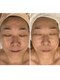 トータルエステティック ジョワイユ(JOYEUX)の写真/毛穴開き黒ずみしみくすみしわをケア！老け顔疲れ顔から若見えリフトアップ目指そう☆