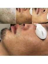 ヴァイオス 八王子(VIOS)/【美肌】多くの男性が美肌実感！