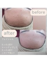 シュガーリングハウスレディ(SugaringHouse LADY)/フェイシャル脱毛