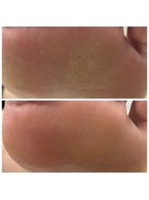 ドクターネイル爪革命 十条店/たこケア