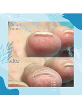 巻き爪補正店 秋葉原店/【巻き爪/陥入爪補正】