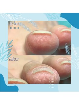 巻き爪補正店 秋葉原店/【巻き爪/陥入爪補正】