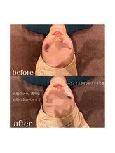 ライム 松本(LIME)/《Hi-UP＊骨格改造×美肌》