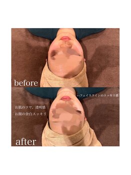 ライム 松本(LIME)/《Hi-UP*骨格改造×美肌》