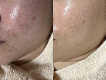 エミュ(emu)/敏感肌荒れケア