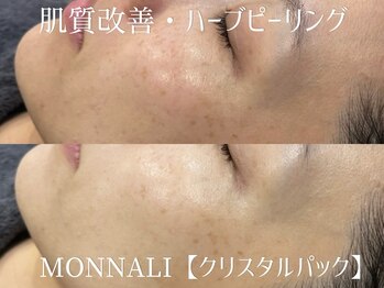 シュアショット(SURE SHOT)/ハーブピーリングで毛穴改善