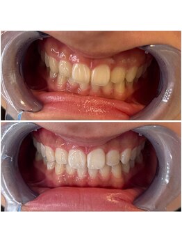 エクシアホワイトニング 代々木店/ビフォーアフター　代々木/新宿