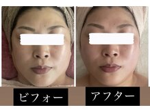 《小顔引き上げたるみ毛穴キュ》ハーブピ&造顔筋&ヘッド10000円