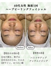 シーフェイス 横浜店(SEE FACE)/40代ハーブピーリングモニター