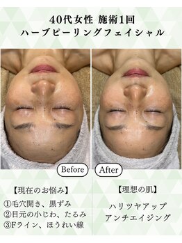 シーフェイス 横浜店(SEE FACE)/40代ハーブピーリングモニター