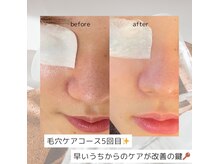 リアン(Lien)/【症例】毛穴ケア 5回の変化
