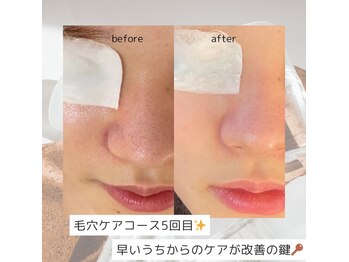 リアン(Lien)/【症例】毛穴ケア 5回の変化