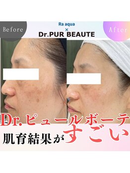 エステティックサロン ラ アクア(ra aqua)/努力した人が報われる肌育結果