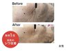 業界注目美容◎(医師監修)神経系幹細胞×エクソソームを最新機器で導入