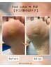 【再来】魚の目/タコケア60分｜足の負担軽減《再来45日以内は特典付》