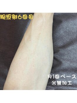 フェリッセ(FELISSE)/腕脱毛 照射 6回目【S様】