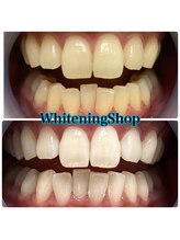 ホワイトニングショップ 立川店/【立川】美白ホワイトニング