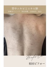 ビューティリュクス(beauty luxe)/背中の肌コンプレックスも