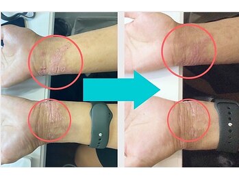 エフ(f)/カサカサ荒れにも効果あり