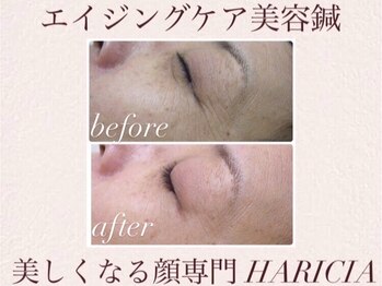 ハリシア(HARICIA)/目まわりのしわの改善