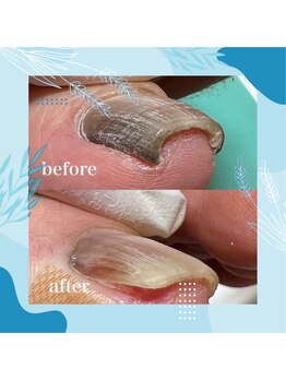 巻き爪補正店 秋葉原店/【巻き爪/陥入爪補正】