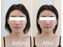 ドクターボディ 新宿店(Dr.Body)/【顔の広がり/小顔　30代】