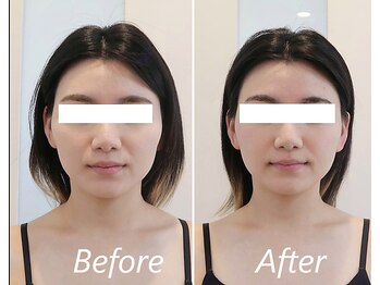 ドクターボディ 新宿店(Dr.Body)/【顔の広がり/小顔 30代】